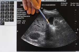 Der Gastroenterologe sieht Gallensteine mittels Ultraschall